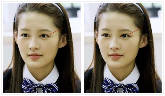 李沁岁数还很小,症状也是最轻的,双眼皮很深,长度稍微偏长.