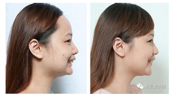 因为有一种下颌后缩,也会看起来下巴很翘,但如果这个时候去做下巴后移