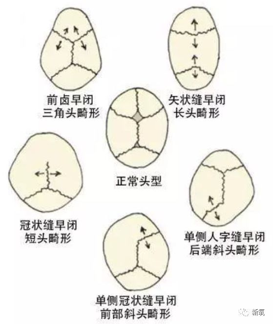 宝宝骨缝一圈凹陷图片图片