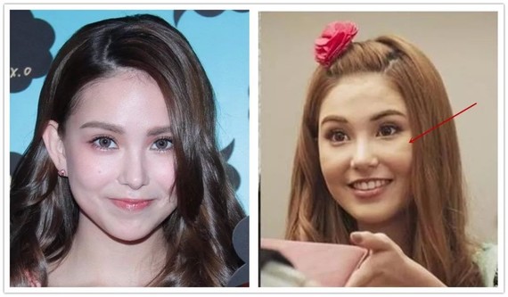 大概率下,这个笑纹会越来越深,最终形成深深的印第安纹沟壑.