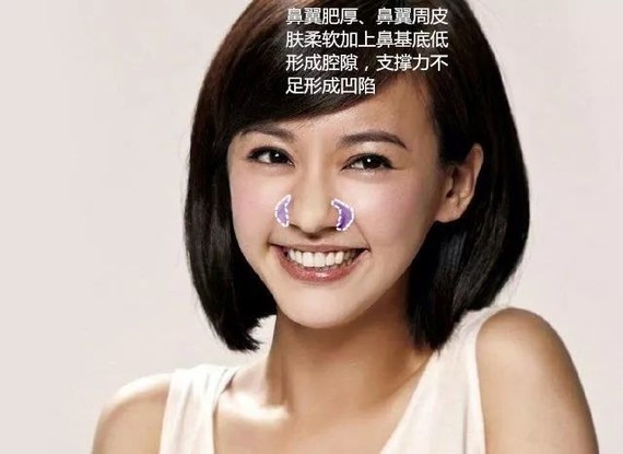 而这里说的"皮肤支撑力不足,且鼻基底不够高"就是"相容性"不够高了.