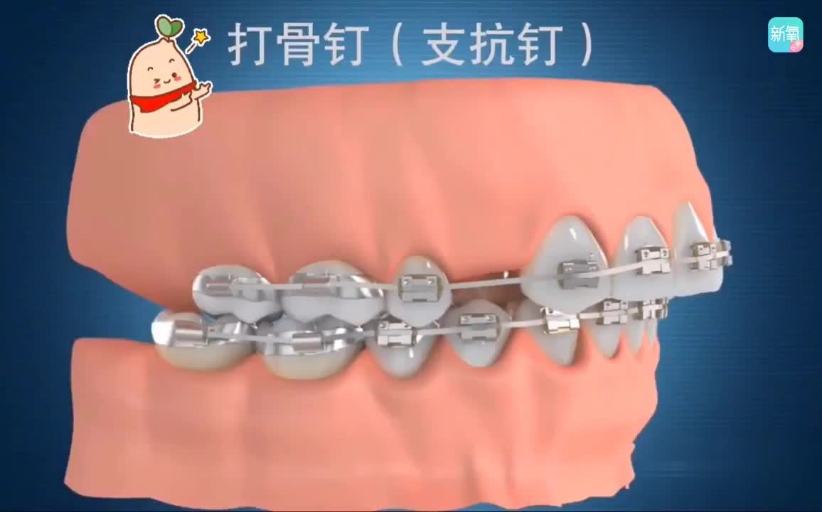 骨钉具体有什么用?(1)利用支抗钉最大程度内收前牙
