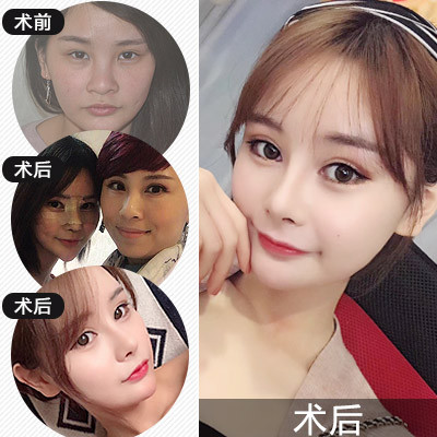 1】欧式挺翘鼻综合五项 @院长主刀 360°塑造匠心美鼻 -新氧美容整形