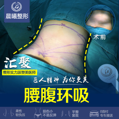 【吸脂】腰部 ,水动力分层精细吸脂 出脂率高 恢复快不留疤 拒绝凹凸