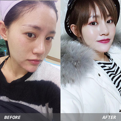 【其他填充剂】ruffy韩国婴儿针2ml 含6种促进细胞活性因子 保湿 抗衰