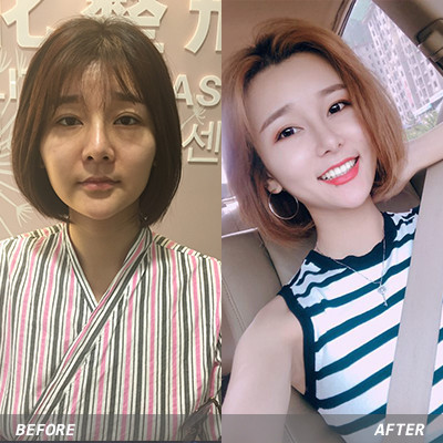 【其他填充剂】ruffy韩国婴儿针2ml 含6种促进细胞活性因子 保湿 抗衰