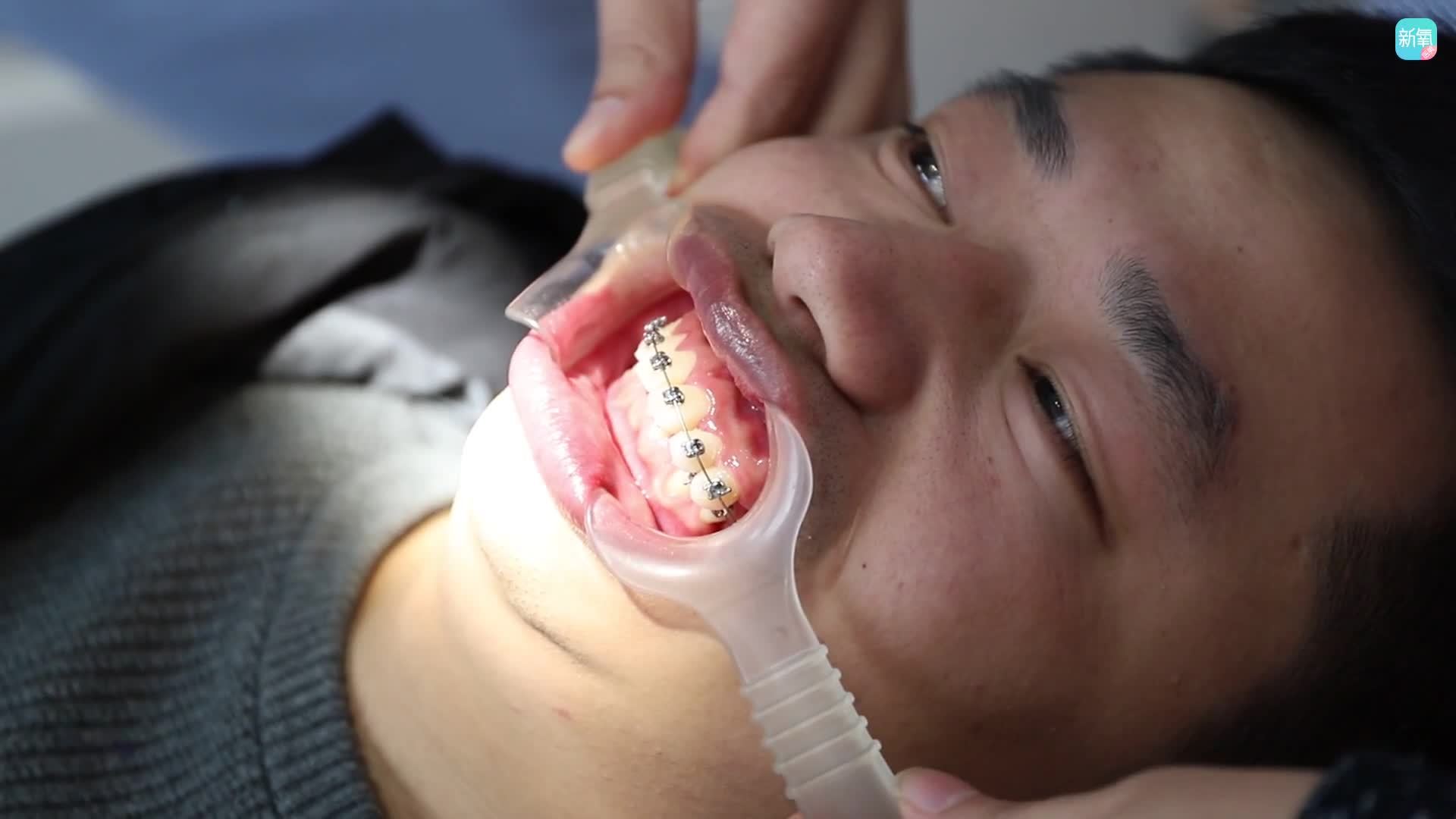 苏州美莱牙齿矫正术后第200天比较在意钢丝的妹子可以用隐形矫正哦我