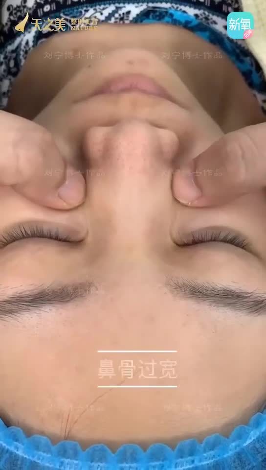 微创无反弹截骨法鼻骨内推同时做了鼻部多项