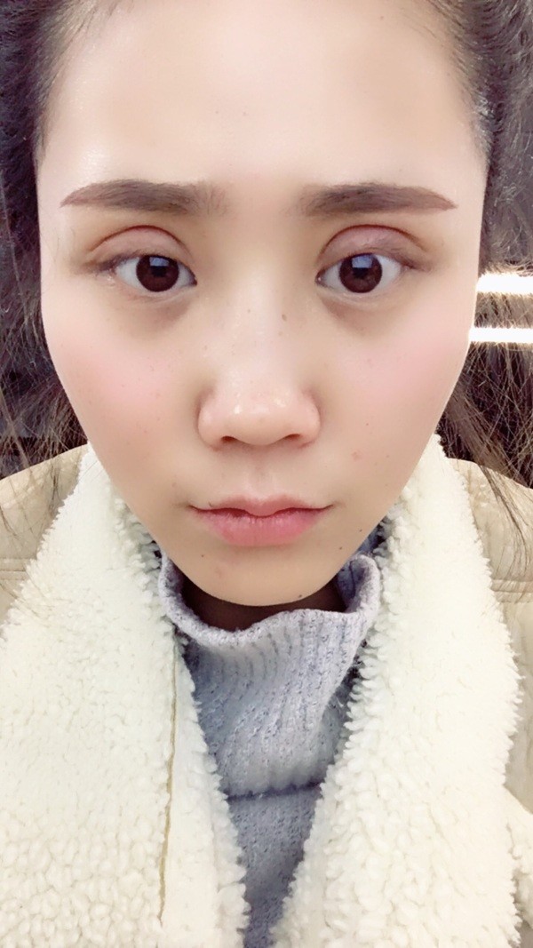 双眼皮肉条很明显怎么办