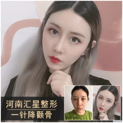 【切开双眼皮】全切双眼皮 原生态翘睫芭比眼 眼部综合 精细切开 保留