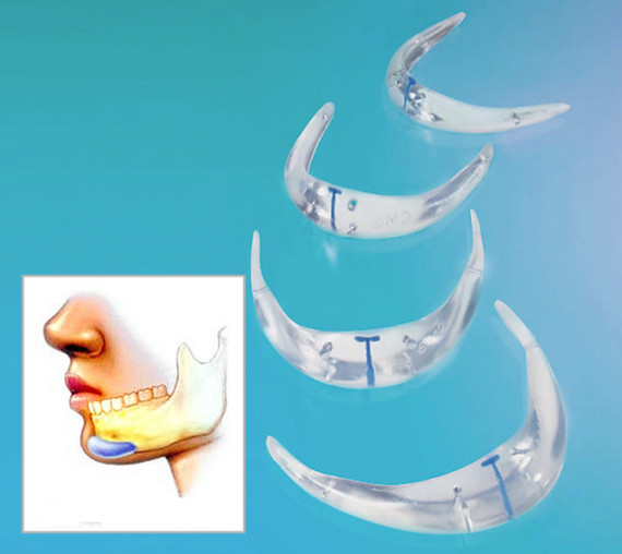 这种治疗适合于填充轻度下颌后缩或优化下颌曲线.