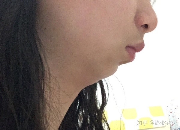 为什么陈意涵明明很瘦 却还有双下巴 新氧 专业医美服务平台