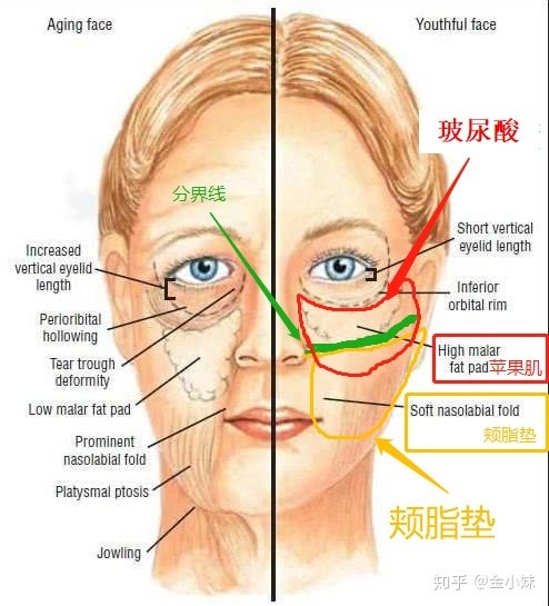 当注射量较大,就有可能部分玻尿酸覆盖了下方的脂肪组织,也就是颊脂垫