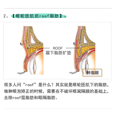 【上眼睑去脂】【祛roof脂肪】肉泡眼消除术/上眼睑去脂/去roof脂肪