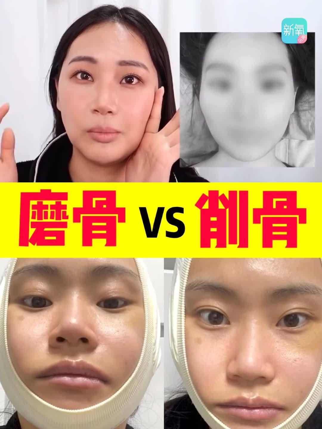 用真人案例告诉你磨骨和削骨的区别