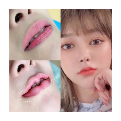 【唇部修复】下唇w唇形成术 下唇增厚 花瓣唇 香肠嘴的福音