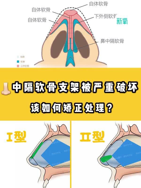 鼻中隔支架被严重破坏的修复方式