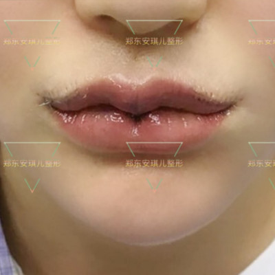 【厚唇改薄】①私信领红包20元②m唇综合/花瓣唇/pp唇③嘴角上扬④厚