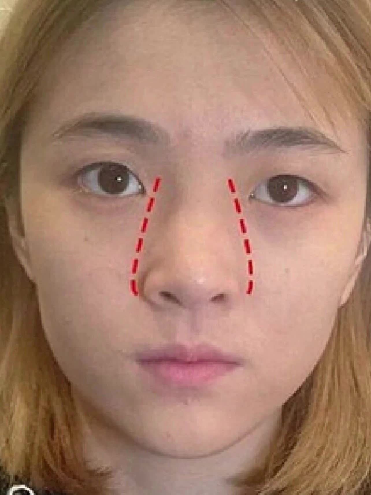 整容后,前男友对我刮目相待!山根低,鼻头大,鼻翼宽_圈子-新氧美容整形