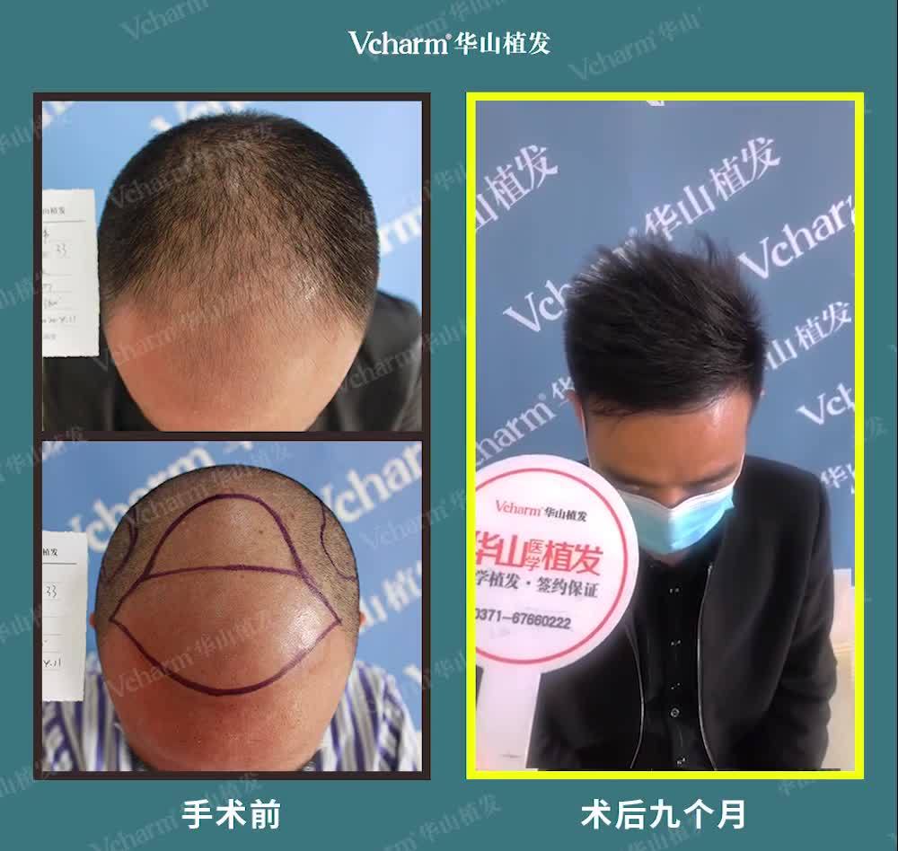 植发案例