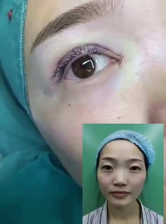 顾客眼部情况:单眼皮,上眼皮外翻显得眼睛不好看,无_圈子-新氧美容