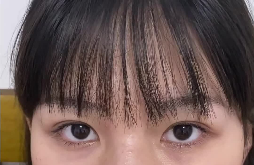 我这个双眼皮是割窄了吗