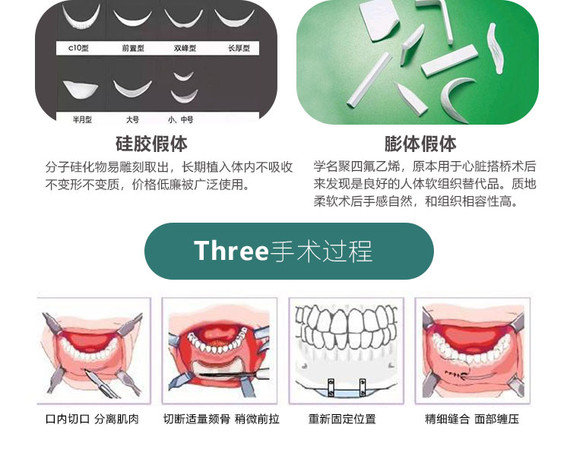 硅膠墊下巴韓士生科面假體假體下巴韓式生科假體拒絕短下巴下巴後縮隆