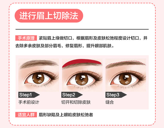 【切眉术】【提眉术】①拯救眼皮下垂②改善眉形