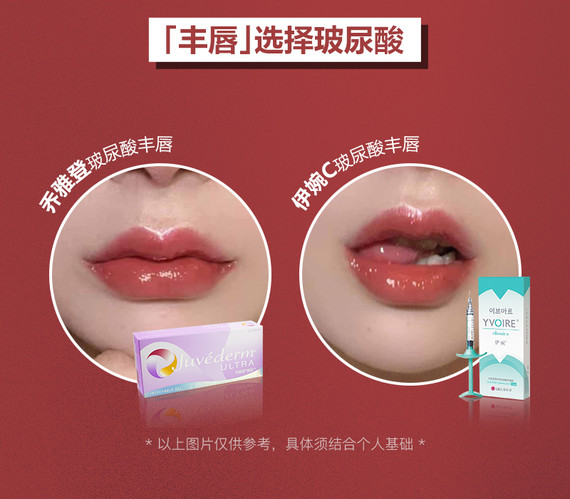 玻尿酸1ml伊婉c丰唇不止玻尿酸手术丰唇乔雅登丰唇伊婉丰唇艺术丰唇唇