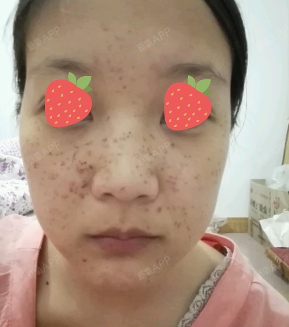 调q激光祛斑后第10天,结痂才脱落了一点点,有好几_圈子-新氧美容整形