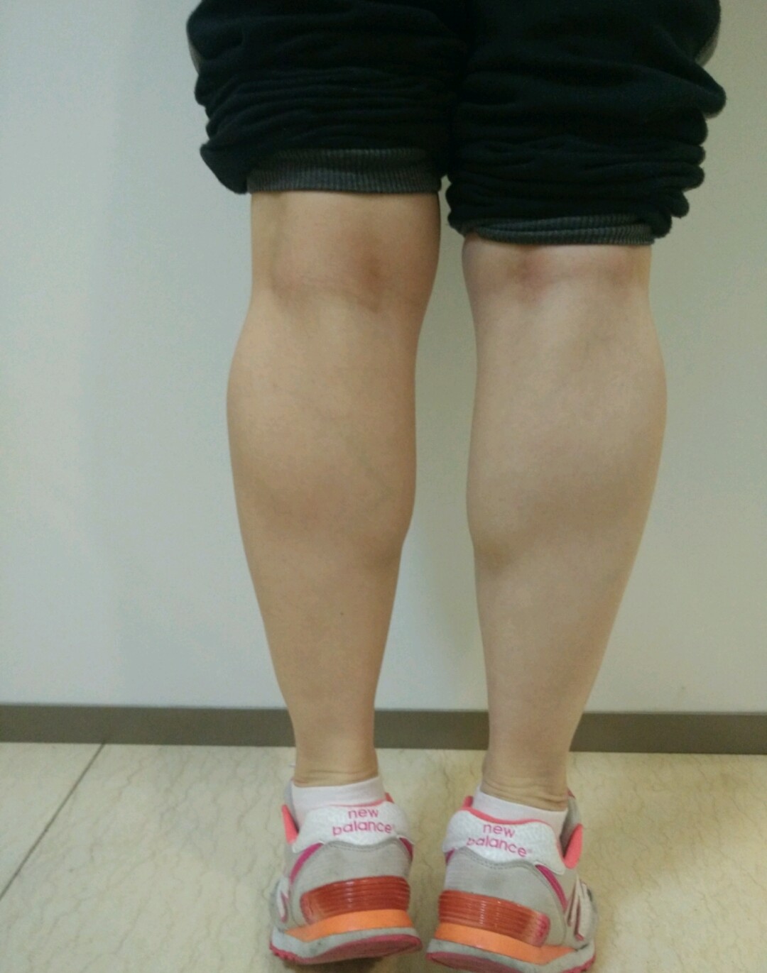 今天去宜健三业医院做肉毒素瘦小腿,早上9点多到的医院,推门进去,里面