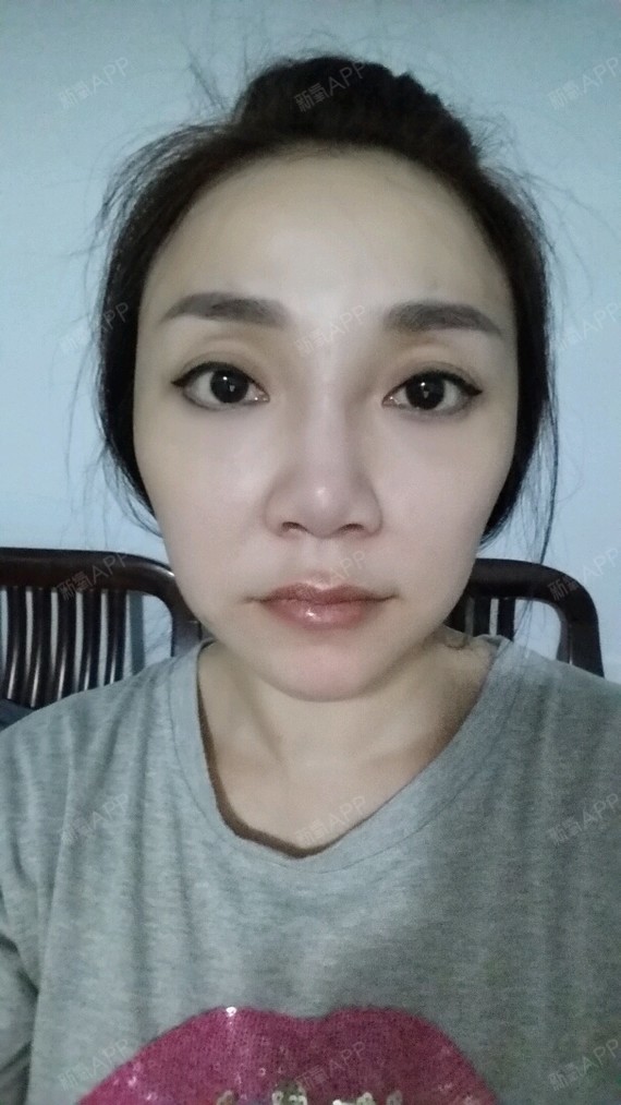 第3天,鼻唇沟还在肿,其它地方逐渐恢复中,只是有木有觉得鼻梁