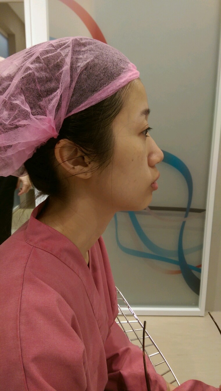 我的客人来谘询鼻子,经由周尔康医生的建议,做了三段式隆鼻,改善他的