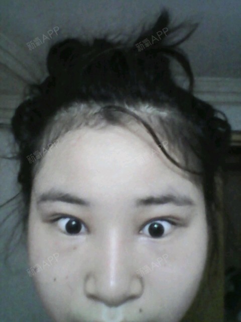 我眼睛眼眶骨突出就是脂肪多抽了脂后会不会_圈子-新氧美容整形