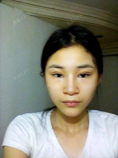 我眼睛适合欧式双眼皮麽我眉眶骨突出眼睛内凹就是眼睛_圈子-新氧美容