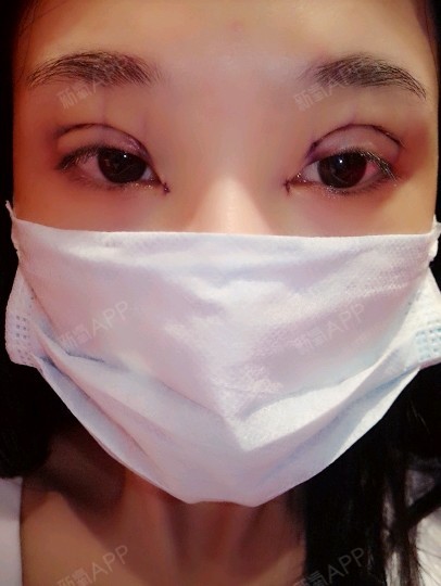 下午刚做完双眼皮,但愿所受的苦都是值得的