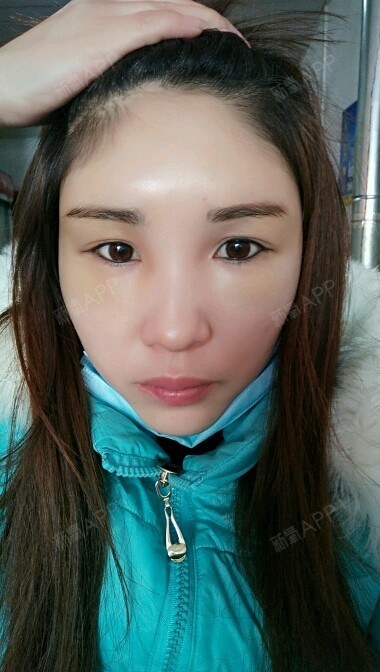 自体脂肪胶填充脸部可以维持多久_自体脂肪胶填充脸部后全部吸收_自体脂肪胶填充脸部可以维持多久