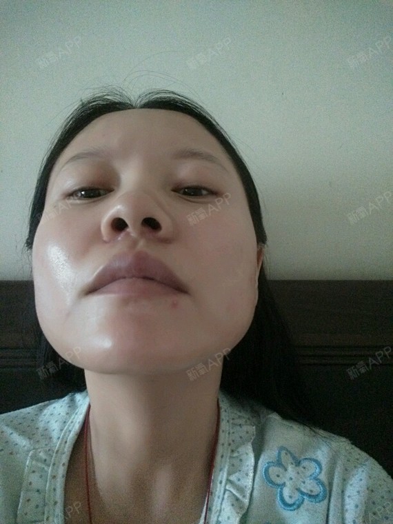 大家帮我看看刚做的鼻翼缩小怎么两边不对称呀,而且觉_圈子-新氧美容