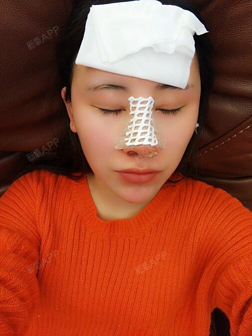 鹰钩鼻整形手术_鹰钩鼻手术多少钱_鹰钩鼻手术详细过程图