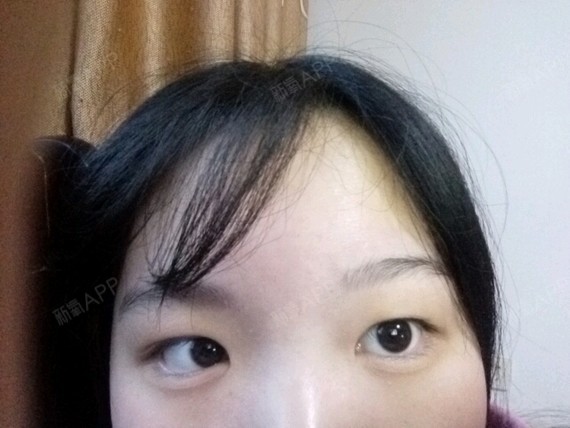 经常贴双眼皮贴,都松了,眼角距离太大了.好无语