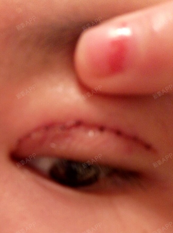 第九天,我左眼伤口有点点裂开了,怎么办怎么办,好焦灼.