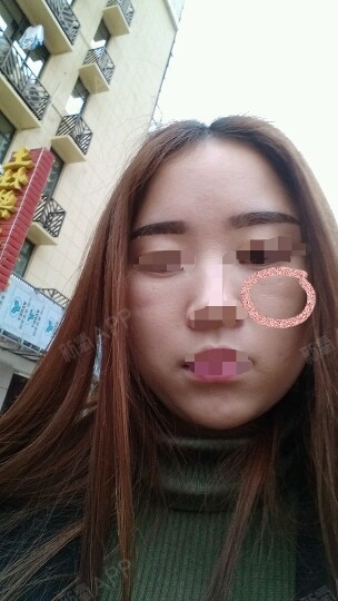 我眼睛下方画圈位置,凹陷特别明显,两边都是,好像天_圈子-新氧美容