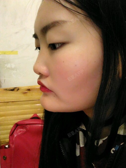 各位亲亲,我下巴骨头有些翘的,然后有很厚的肉这种能_圈子-新氧美容