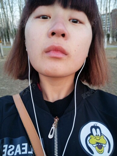 手术缩小鼻头 | 鼻尖整形 | 手术缩小鼻翼 | 鼻翼缩小 | 开内眼角