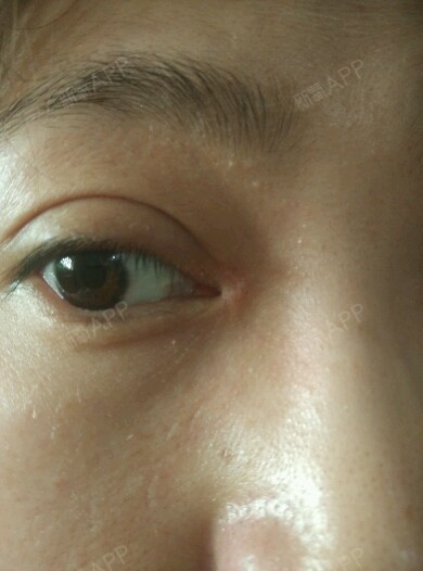开眼角15天了一直都是白色的疤是不是不会好了,要怎