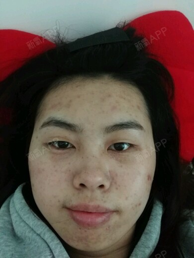 第二次做光子嫩肤一周后,之前反黑,今天多数痂都掉了_圈子-新氧美容