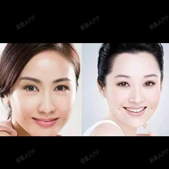 我喜欢这种梨涡,看最近好多做埋线的,但是我又担心做不好了就是坑还不