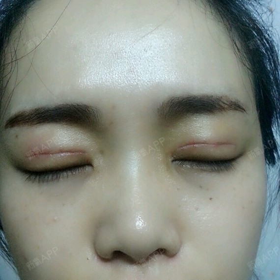 基本就等一个月恢复成自然型,现在还是有点肿的只不过不明显,还是有点
