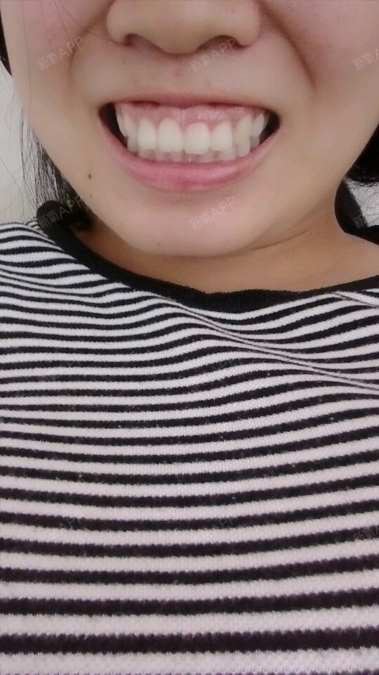 咬合关系好像不对,放松状态上牙是完_圈子-新氧美容整形