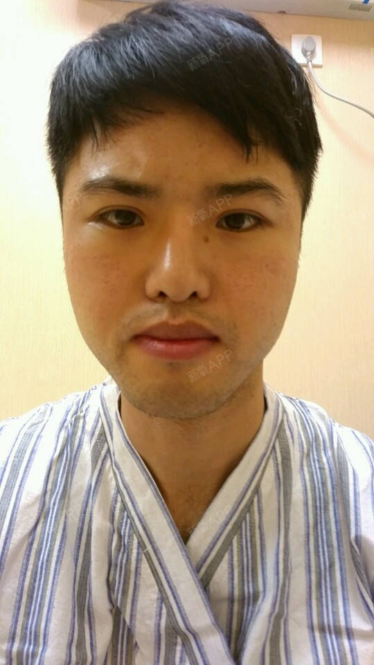 其实我是自体脂肪填充的鼻基底,项目里没找到就选了法_圈子-新氧美容